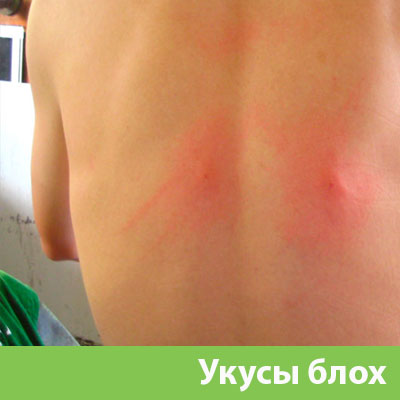 Укусы блох в Симферополе
