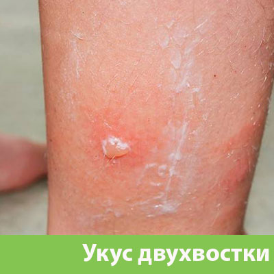Укус двухвостки в Симферополе