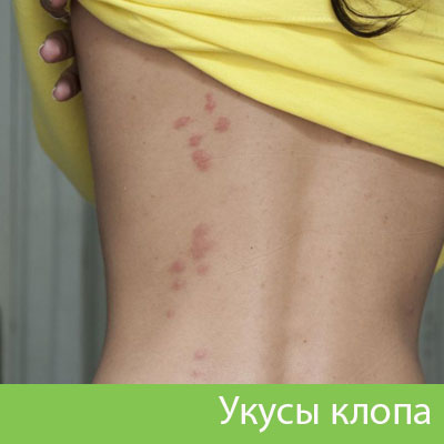 Профессиональное уничтожение клопов в Симферополе
